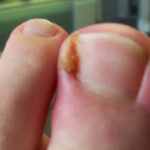 Izbjegnite bol, urastanje i ružan izgled: Kako se pravilno sijeku nokti na nogama