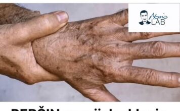 PERŠIN Zauvijek Uklanja STARAČKE MRLJE! Ovo Morate Napraviti…