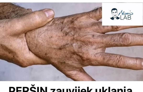 PERŠIN Zauvijek Uklanja STARAČKE MRLJE! Ovo Morate Napraviti…