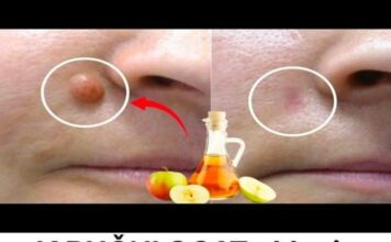 JABUČNI 0CAT uklanja BRADAVICE za 24 SATA! Samo napravite 0v0… JABUČNI 0CAT uklanja BRADAVICE za 24 SATA! Samo napravite 0v0…