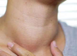 Karcinom štitne žlijezde se najteže otkriva: Ovo su prvi simptomi, ne ignorirajte ih Karcinom štitne žlijezde se najteže otkriva: Ovo su prvi simptomi, ne ignorirajte ih