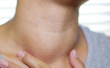 Karcinom štitne žlijezde se najteže otkriva: Ovo su prvi simptomi, ne ignorirajte ih Karcinom štitne žlijezde se najteže otkriva: Ovo su prvi simptomi, ne ignorirajte ih