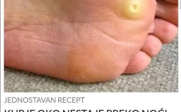 KURJE OKO NESTAJE PREKO NOĆI, STAVITE OVU BILJKU NA NJEGA KURJE OKO NESTAJE PREKO NOĆI, STAVITE OVU BILJKU NA NJEGA