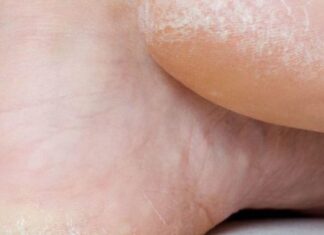 BILO ME STID MOJIH GRUBIH PETA, A ONDA SAM OTKRILA TRIK: Sva Stara Koža Je Nestala, BRZO ZAPIŠITE RECEPT BILO ME STID MOJIH GRUBIH PETA, A ONDA SAM OTKRILA TRIK: Sva Stara Koža Je Nestala, BRZO ZAPIŠITE RECEPT