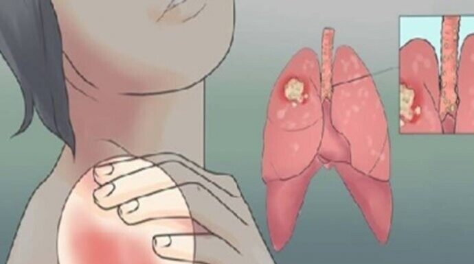 EVO KAKO MOŽETE PROVJERITI DA LI IMATE SLAB IMUNITET: 6 Znakova Lošeg Imuniteta, Ovako Tijelo Upozorava EVO KAKO MOŽETE PROVJERITI DA LI IMATE SLAB IMUNITET: 6 Znakova Lošeg Imuniteta, Ovako Tijelo Upozorava