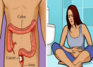 EVO KAKO PREPOZNATI RAK DEBELOG CRIJEVA NA VRIJEME: Ne čekajte ni sekund, ODMAH IDITE DOKTORU ako ovo primijetite! EVO KAKO PREPOZNATI RAK DEBELOG CRIJEVA NA VRIJEME: Ne čekajte ni sekund, ODMAH IDITE DOKTORU ako ovo primijetite!