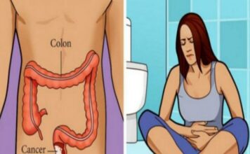 EVO KAKO PREPOZNATI RAK DEBELOG CRIJEVA NA VRIJEME: Ne čekajte ni sekund, ODMAH IDITE DOKTORU ako ovo primijetite! EVO KAKO PREPOZNATI RAK DEBELOG CRIJEVA NA VRIJEME: Ne čekajte ni sekund, ODMAH IDITE DOKTORU ako ovo primijetite!