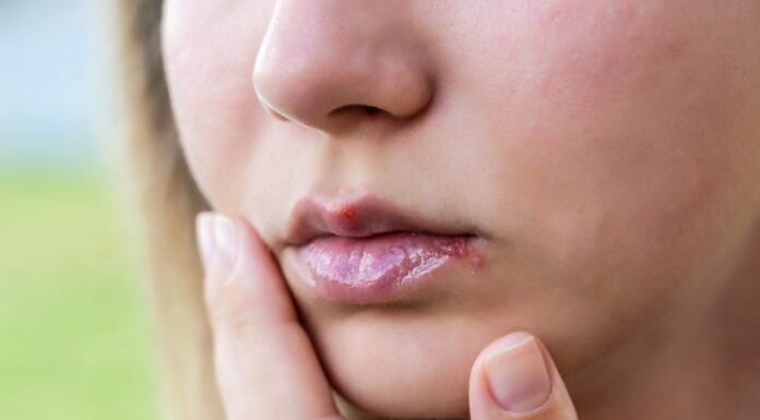 Mononukleoza – kako izgledaju simptomi "bolesti poljupca"? Mononukleoza – kako izgledaju simptomi "bolesti poljupca"?