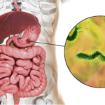 Ova bakterija je najveći neprijatelj želuca: Lako se zarazite, a posledice mogu biti opasne – obratite pažnju na 1 stvar