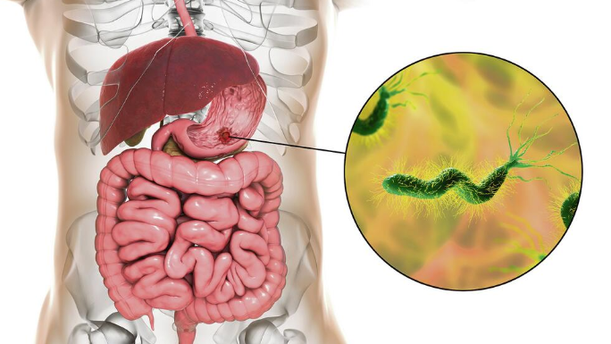 Ova bakterija je najveći neprijatelj želuca: Lako se zarazite, a posledice mogu biti opasne – obratite pažnju na 1 stvar Ova bakterija je najveći neprijatelj želuca: Lako se zarazite, a posledice mogu biti opasne – obratite pažnju na 1 stvar