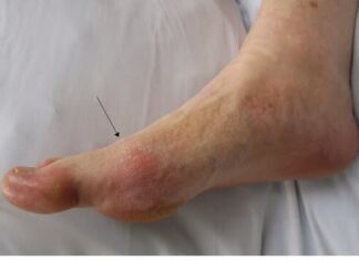 OVO SU ZNAKOVI DA VAM ŠEĆER RAZARA ORGANIZAM: Obratite pažnju OVO SU ZNAKOVI DA VAM ŠEĆER RAZARA ORGANIZAM: Obratite pažnju