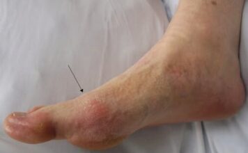 OVO SU ZNAKOVI DA VAM ŠEĆER RAZARA ORGANIZAM: Obratite pažnju OVO SU ZNAKOVI DA VAM ŠEĆER RAZARA ORGANIZAM: Obratite pažnju