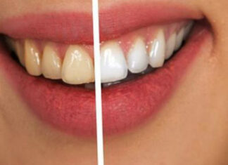 SODA BIKARBONA I LIMUN ŠTETE ZUBIMA: Nikad ne biste pogodili šta ih izbjeljuje! SODA BIKARBONA I LIMUN ŠTETE ZUBIMA: Nikad ne biste pogodili šta ih izbjeljuje!