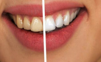 SODA BIKARBONA I LIMUN ŠTETE ZUBIMA: Nikad ne biste pogodili šta ih izbjeljuje! SODA BIKARBONA I LIMUN ŠTETE ZUBIMA: Nikad ne biste pogodili šta ih izbjeljuje!