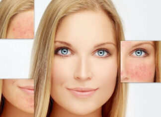 Šta je aktivni kiseonik i kako deluje na: Bubuljice, akne, mitisere, ožiljke, upale… Šta je aktivni kiseonik i kako deluje na: Bubuljice, akne, mitisere, ožiljke, upale…