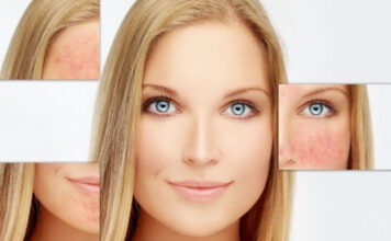 Šta je aktivni kiseonik i kako deluje na: Bubuljice, akne, mitisere, ožiljke, upale… Šta je aktivni kiseonik i kako deluje na: Bubuljice, akne, mitisere, ožiljke, upale…