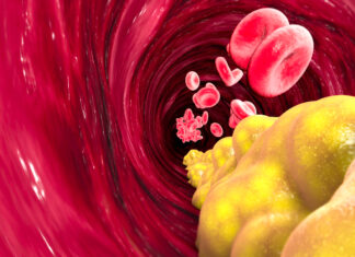 Šta se dešava sa vašim tijelom kada imate visok holesterol? Šta se dešava sa vašim tijelom kada imate visok holesterol?