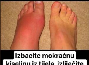 Uklonite mokraćnu kiselinu iz tijela i liječite giht: 3 narodna lijeka dokazano učinkovita! Uklonite mokraćnu kiselinu iz tijela i liječite giht: 3 narodna lijeka dokazano učinkovita!