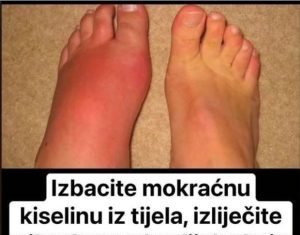 Uklonite mokraćnu kiselinu iz tijela i liječite giht: 3 narodna lijeka dokazano učinkovita! Uklonite mokraćnu kiselinu iz tijela i liječite giht: 3 narodna lijeka dokazano učinkovita!