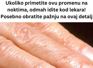 Ukoliko primetite ovu promenu na noktima, odmah idite kod lekara! Posebno obratite pažnju na ovaj detalj Ukoliko primetite ovu promenu na noktima, odmah idite kod lekara! Posebno obratite pažnju na ovaj detalj