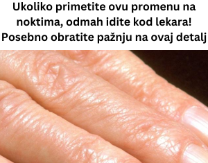Ukoliko primetite ovu promenu na noktima, odmah idite kod lekara! Posebno obratite pažnju na ovaj detalj Ukoliko primetite ovu promenu na noktima, odmah idite kod lekara! Posebno obratite pažnju na ovaj detalj