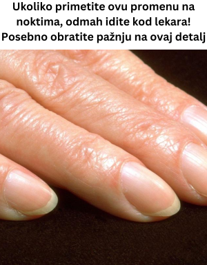 Ukoliko primetite ovu promenu na noktima, odmah idite kod lekara! Posebno obratite pažnju na ovaj detalj Ukoliko primetite ovu promenu na noktima, odmah idite kod lekara! Posebno obratite pažnju na ovaj detalj