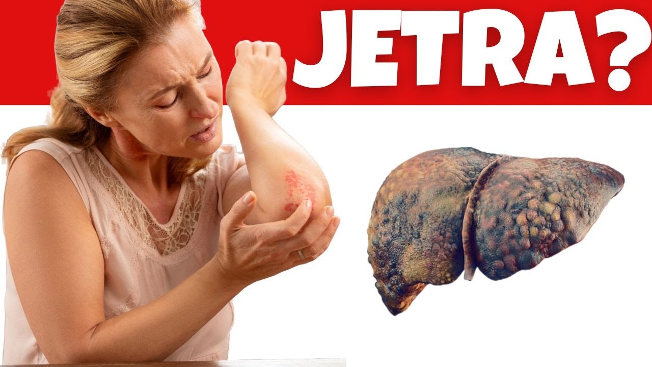 Evo kako se bolesna jetra pokazuje na koži,nogama OVO SU SIMPTOMI BOLESNE JETRE… Evo kako se bolesna jetra pokazuje na koži,nogama OVO SU SIMPTOMI BOLESNE JETRE…