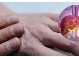 Ove simptome bolesti jetre velika većina ljudi podcjenjuje: Ako primijetite ovu pojavu na svojoj koži, NEMATE PUNO VREMENA Ove simptome bolesti jetre velika većina ljudi podcjenjuje: Ako primijetite ovu pojavu na svojoj koži, NEMATE PUNO VREMENA