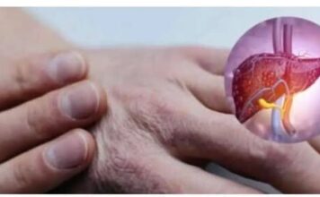 Ove simptome bolesti jetre velika većina ljudi podcjenjuje: Ako primijetite ovu pojavu na svojoj koži, NEMATE PUNO VREMENA Ove simptome bolesti jetre velika većina ljudi podcjenjuje: Ako primijetite ovu pojavu na svojoj koži, NEMATE PUNO VREMENA