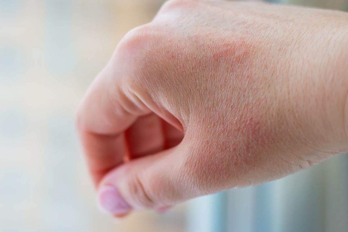 Simptomi alergije na hladnoću: Kako prepoznati ozbiljne reakcije? Simptomi alergije na hladnoću: Kako prepoznati ozbiljne reakcije?