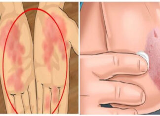 JEDINSTVENA RECEPTURA ZA LIJEČENJE KOŽNIH BOLESTI: Ovaj specijalni eliksir liječi sve kožne bolesti JEDINSTVENA RECEPTURA ZA LIJEČENJE KOŽNIH BOLESTI: Ovaj specijalni eliksir liječi sve kožne bolesti