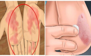 JEDINSTVENA RECEPTURA ZA LIJEČENJE KOŽNIH BOLESTI: Ovaj specijalni eliksir liječi sve kožne bolesti JEDINSTVENA RECEPTURA ZA LIJEČENJE KOŽNIH BOLESTI: Ovaj specijalni eliksir liječi sve kožne bolesti