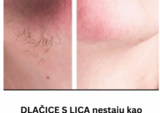 DLAČICE S LICA nestaju kao rukom odnesene:Sve žene širom svijeta potpuno su poludile za ovim receptom!
