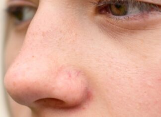 Ispucali kapilari ukazuju na probleme s jetrom Ispucali kapilari ukazuju na probleme s jetrom