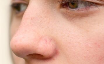 Ispucali kapilari ukazuju na probleme s jetrom Ispucali kapilari ukazuju na probleme s jetrom