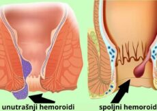 Kako pravilno lečiti hemoroide kod kuće