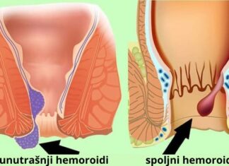 Kako pravilno lečiti hemoroide kod kuće Kako pravilno lečiti hemoroide kod kuće