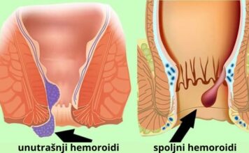 Kako pravilno lečiti hemoroide kod kuće Kako pravilno lečiti hemoroide kod kuće
