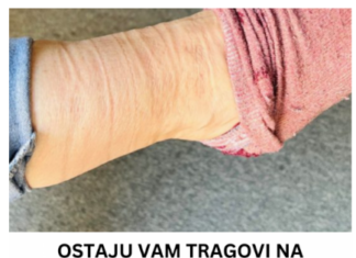 OSTAJU VAM TRAGOVI NA NOGAMA KADA SKINETE ČARAPE? Evo šta to govori o vašem zdravlju, nikako ne ignorište ovu pojavu OSTAJU VAM TRAGOVI NA NOGAMA KADA SKINETE ČARAPE? Evo šta to govori o vašem zdravlju, nikako ne ignorište ovu pojavu