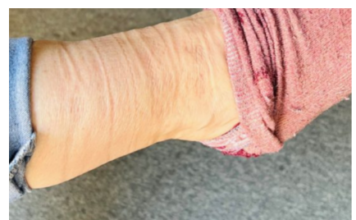 OSTAJU VAM TRAGOVI NA NOGAMA KADA SKINETE ČARAPE? Evo šta to govori o vašem zdravlju, nikako ne ignorište ovu pojavu OSTAJU VAM TRAGOVI NA NOGAMA KADA SKINETE ČARAPE? Evo šta to govori o vašem zdravlju, nikako ne ignorište ovu pojavu