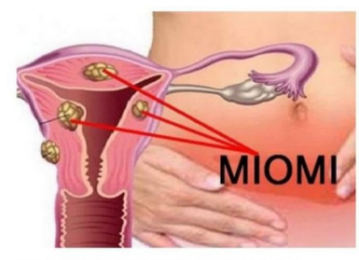 PRVI SIMPTOM MIOMA MATERICE: Žene, obratite pažnju dok nije kasno, ako ovo uočite – Trk kod ginekologa PRVI SIMPTOM MIOMA MATERICE: Žene, obratite pažnju dok nije kasno, ako ovo uočite – Trk kod ginekologa