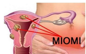 PRVI SIMPTOM MIOMA MATERICE: Žene, obratite pažnju dok nije kasno, ako ovo uočite – Trk kod ginekologa PRVI SIMPTOM MIOMA MATERICE: Žene, obratite pažnju dok nije kasno, ako ovo uočite – Trk kod ginekologa
