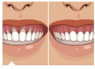 Samo Promućkajte Ovu ČUDNU Stvar U Ustima I Gledajte Kako Vam Se DESNI Za Par Dana Vraćaju U Prvobitno Stanje! Samo Promućkajte Ovu ČUDNU Stvar U Ustima I Gledajte Kako Vam Se DESNI Za Par Dana Vraćaju U Prvobitno Stanje!
