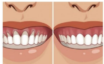 Samo Promućkajte Ovu ČUDNU Stvar U Ustima I Gledajte Kako Vam Se DESNI Za Par Dana Vraćaju U Prvobitno Stanje! Samo Promućkajte Ovu ČUDNU Stvar U Ustima I Gledajte Kako Vam Se DESNI Za Par Dana Vraćaju U Prvobitno Stanje!
