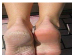 Zaboravite na ispucale pete, kurje oko i gljivice na nogama: Jeftina namirnica je pravi spas Zaboravite na ispucale pete, kurje oko i gljivice na nogama: Jeftina namirnica je pravi spas