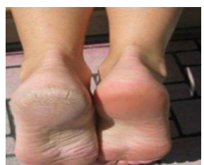 Zaboravite na ispucale pete, kurje oko i gljivice na nogama: Jeftina namirnica je pravi spas Zaboravite na ispucale pete, kurje oko i gljivice na nogama: Jeftina namirnica je pravi spas