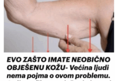 EVO ZAŠTO IMATE NEOBIČNO OBJEŠENU KOŽU- Većina ljudi nema pojma o ovom problemu. Jedino efikasno rješenje je ovaj domaći trik