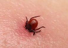 Kako izvaditi krpelja ako ste daleko od ambulante