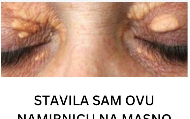 STAVILA SAM OVU NAMIRNICU NA MASNO TKIVO KOD OKA, ono je preko noći nestalo: EVO ŠTA ME SPASILO, SVI GA IMATE U KUĆI STAVILA SAM OVU NAMIRNICU NA MASNO TKIVO KOD OKA, ono je preko noći nestalo: EVO ŠTA ME SPASILO, SVI GA IMATE U KUĆI