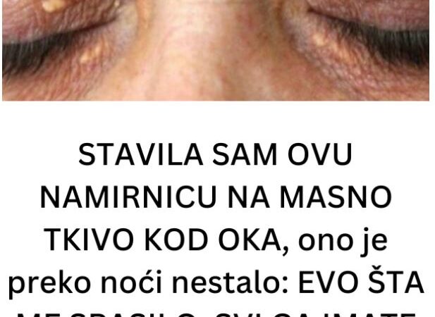 STAVILA SAM OVU NAMIRNICU NA MASNO TKIVO KOD OKA, ono je preko noći nestalo: EVO ŠTA ME SPASILO, SVI GA IMATE U KUĆI
